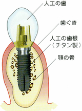 違和感無く、まるでご自分の歯がよみがえったようなインプラントをご想像下さい